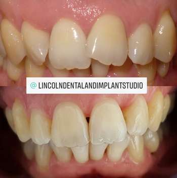 Patient smile transformation 1