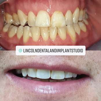 Patient smile transformation 2