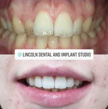 Patient smile transformation 3
